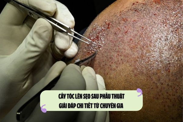 Cấy tóc lên sẹo sau phẫu thuật: Giải đáp chi tiết từ chuyên gia 