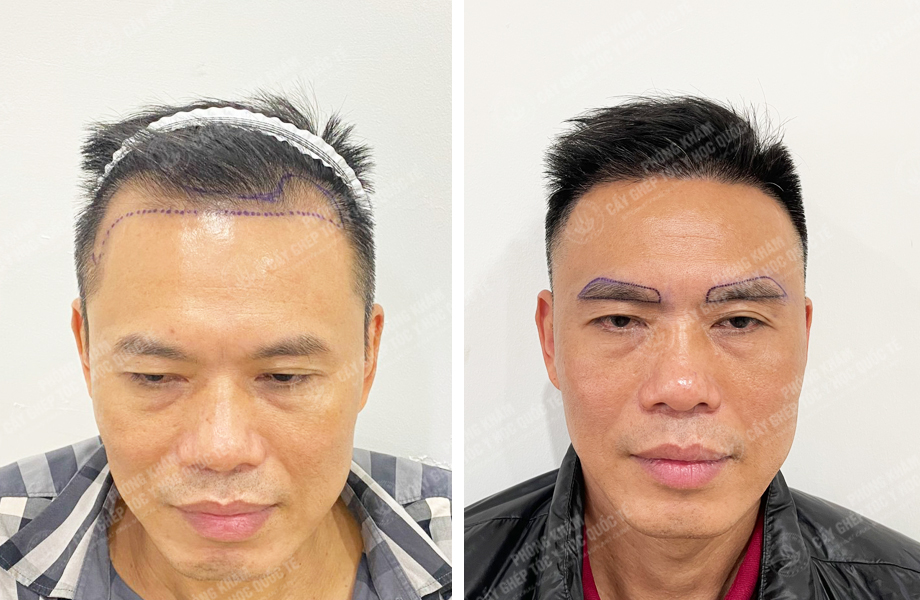  Đào Văn Minh - Cấy tóc đường chữ M 1