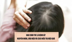 Đau chân tóc là bệnh gì? Nguyên nhân, dấu hiệu và cách điều trị hiệu quả
