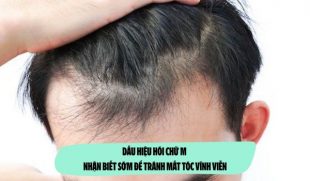 Dấu hiệu hói chữ M: Nhận biết sớm để tránh mất tóc vĩnh viễn