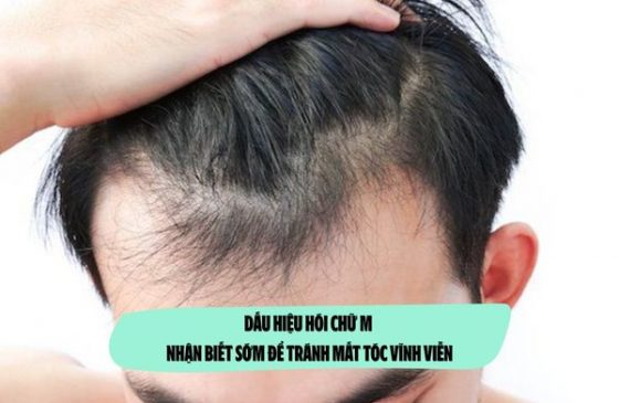 Dấu hiệu hói chữ M: Nhận biết sớm để tránh mất tóc vĩnh viễn