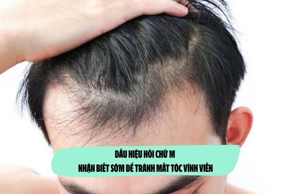 Dấu hiệu hói chữ M: Nhận biết sớm để tránh mất tóc vĩnh viễn