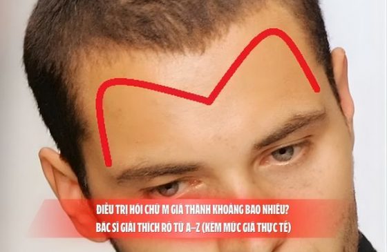 Điều trị hói chữ M giá thành khoảng bao nhiêu? Bác sĩ giải thích rõ từ A–Z (kèm mức giá thực tế)