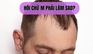 Hói chữ M phải làm sao? Sai lầm phổ biến khiến tóc không thể mọc lại