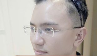 Hói chữ M 1 bên là gì? Nguyên nhân và giải pháp phục hồi tóc hiệu quả