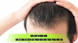 Hói chữ M bẩm sinh – Bác sĩ chia sẻ cách cải thiện hiệu quả theo từng mức độ