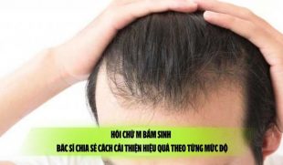 Hói chữ M bẩm sinh – Bác sĩ chia sẻ cách cải thiện hiệu quả theo từng mức độ