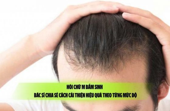 Hói chữ M bẩm sinh – Bác sĩ chia sẻ cách cải thiện hiệu quả theo từng mức độ