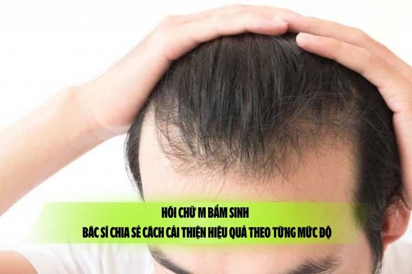 Hói chữ M bẩm sinh – Bác sĩ chia sẻ cách cải thiện hiệu quả theo từng mức độ