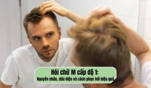 Hói chữ M cấp độ 1: Nguyên nhân, dấu hiệu và cách phục hồi hiệu quả