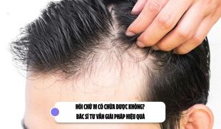 Hói chữ M có chữa được không? Bác sĩ tư vấn giải pháp hiệu quả