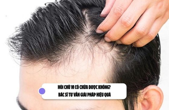 Hói chữ M có chữa được không? Bác sĩ tư vấn giải pháp hiệu quả