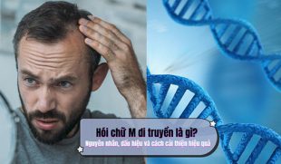 Hói chữ M di truyền là gì? Nguyên nhân, dấu hiệu và cách cải thiện hiệu quả