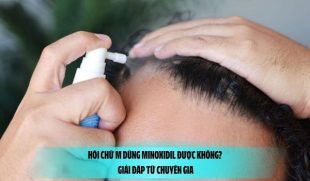 Hói chữ M dùng Minoxidil được không? Giải đáp từ chuyên gia