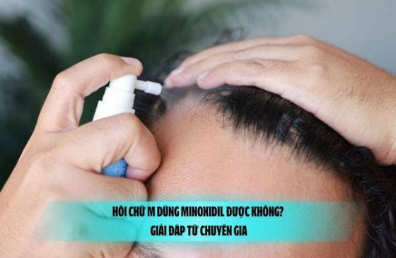 Hói chữ M dùng Minoxidil được không? Giải đáp từ chuyên gia