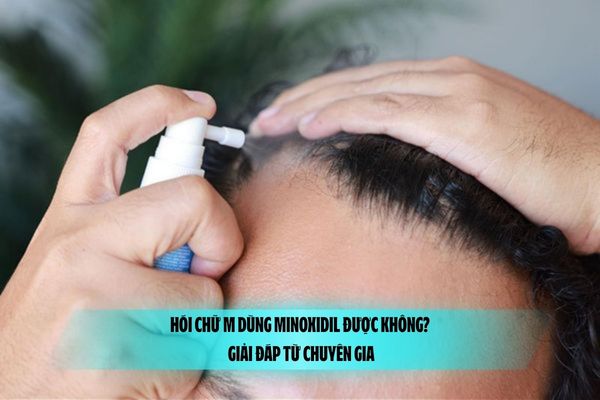 Hói chữ M dùng Minoxidil được không? Giải đáp từ chuyên gia