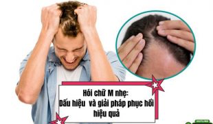 Hói chữ M nhẹ: Dấu hiệu sớm của rụng tóc nam và giải pháp phục hồi hiệu quả