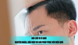 Hói chữ M ở nam: Nguyên nhân, dấu hiệu và giải pháp phục hồi hiệu quả