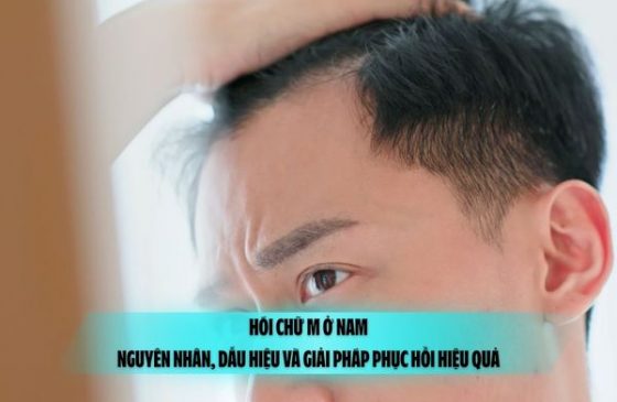 Hói chữ M ở nam: Nguyên nhân, dấu hiệu và giải pháp phục hồi hiệu quả