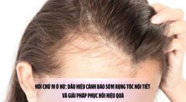 Hói chữ M ở nữ: Dấu hiệu cảnh báo sớm rụng tóc nội tiết và giải pháp phục hồi hiệu quả
