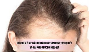 Hói chữ M ở nữ: Dấu hiệu cảnh báo sớm rụng tóc nội tiết và giải pháp phục hồi hiệu quả