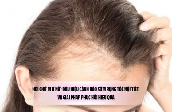 Hói chữ M ở nữ: Dấu hiệu cảnh báo sớm rụng tóc nội tiết và giải pháp phục hồi hiệu quả