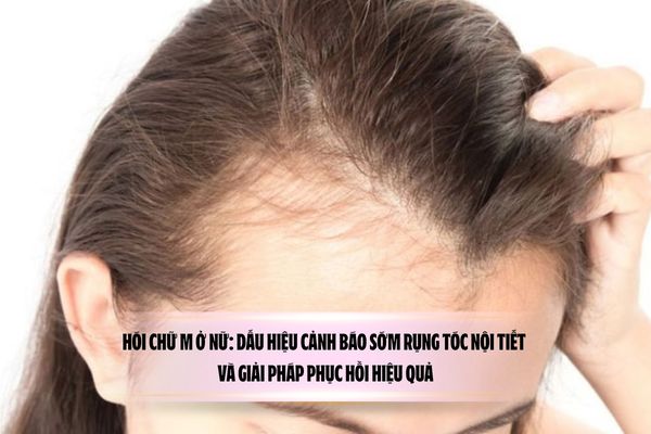 Hói chữ M ở nữ: Dấu hiệu cảnh báo sớm rụng tóc nội tiết và giải pháp phục hồi hiệu quả