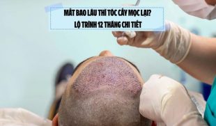 Mất bao lâu thì tóc cấy mọc lại? Lộ trình 12 tháng chi tiết