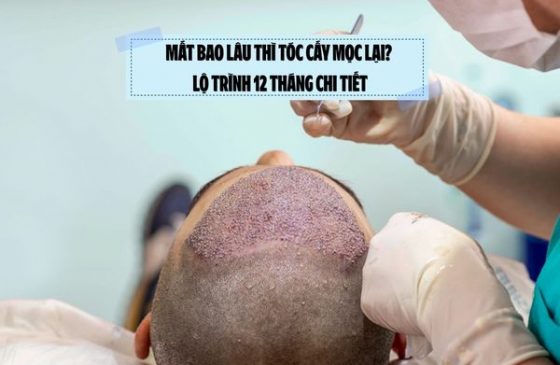 Mất bao lâu thì tóc cấy mọc lại? Lộ trình 12 tháng chi tiết