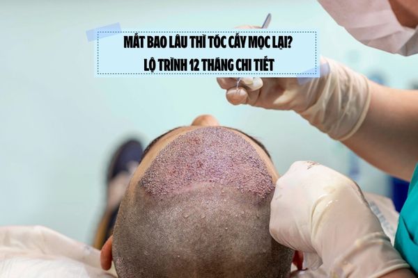 Mất bao lâu thì tóc cấy mọc lại? Lộ trình 12 tháng chi tiết