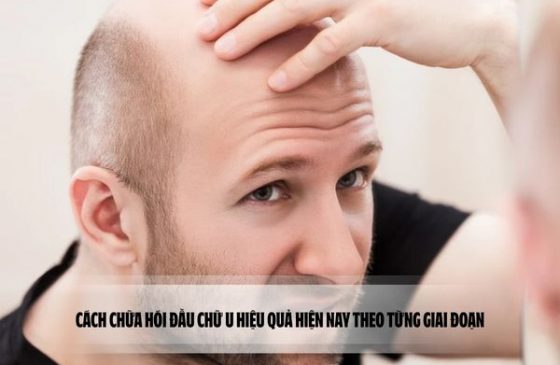 Cách chữa hói đầu chữ U hiệu quả hiện nay theo từng giai đoạn