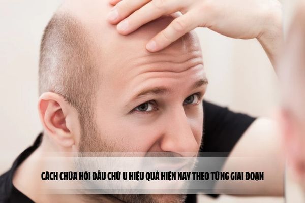 Cách chữa hói đầu chữ U hiệu quả hiện nay theo từng giai đoạn