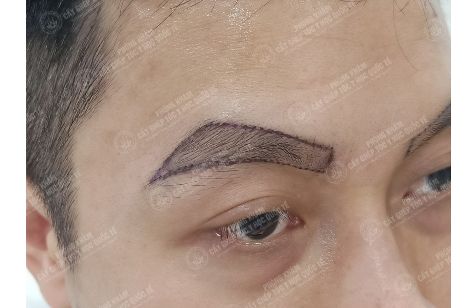 Vũ Văn Hoàn - Cấy lông mày 2