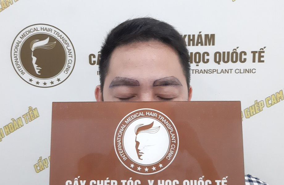 Trịnh Thái Sơn - Cấy lông mày 2