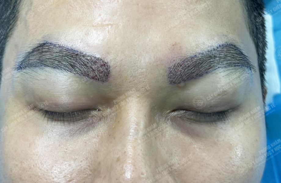 Vũ Văn Hoàn - Cấy lông mày 3