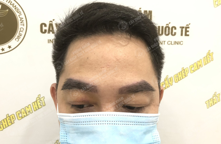 Trịnh Thái Sơn - Cấy lông mày 3