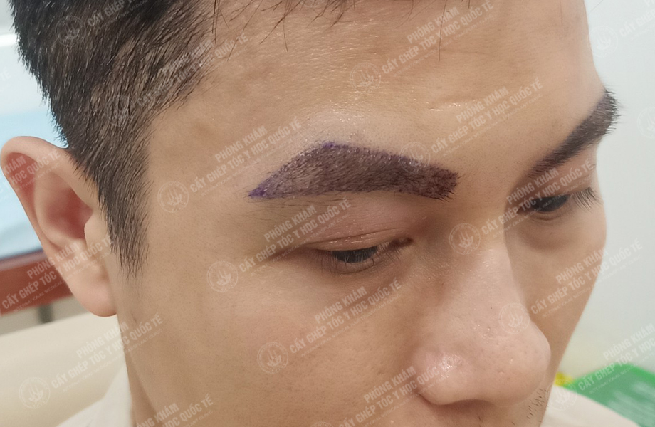 Vũ Văn Hoàn - Cấy lông mày 4