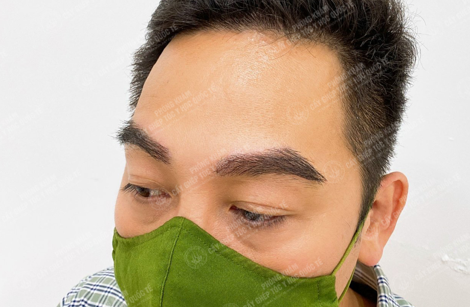 Trịnh Thái Sơn - Cấy lông mày 4