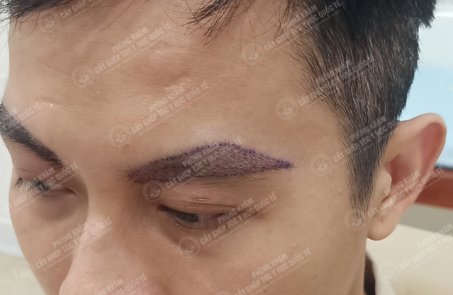 Vũ Văn Hoàn - Cấy lông mày 5