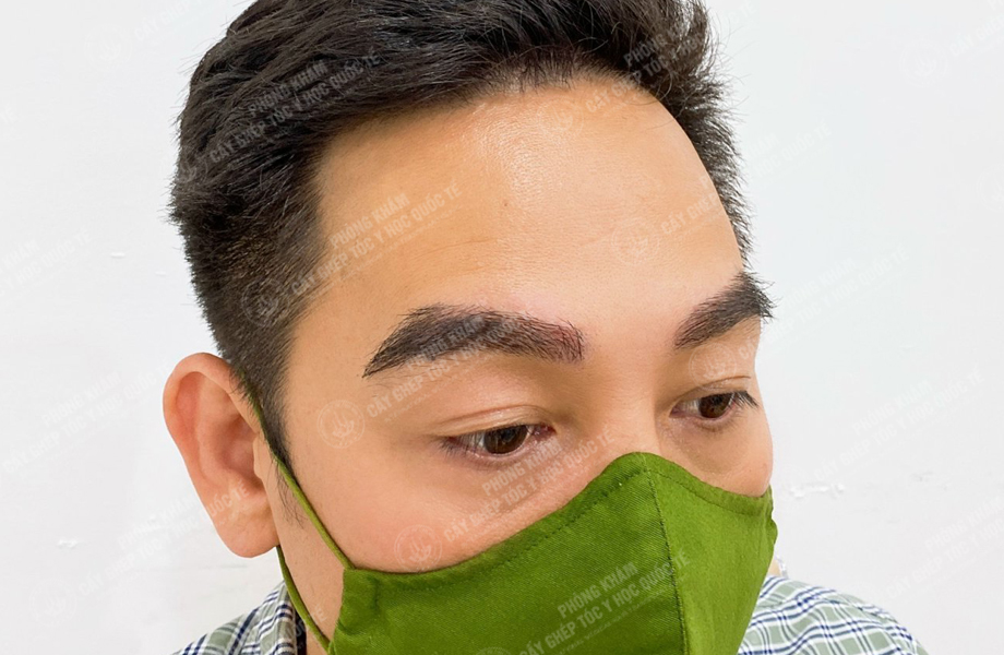 Trịnh Thái Sơn - Cấy lông mày 5