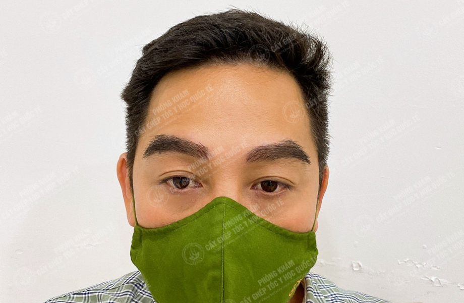 Trịnh Thái Sơn - Cấy lông mày 6