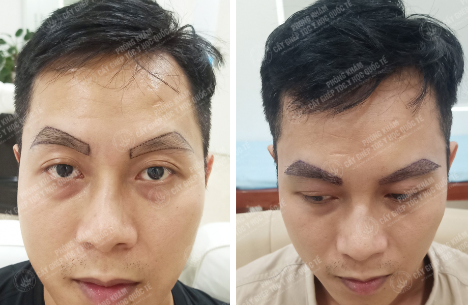  Vũ Văn Hoàn - Cấy lông mày 1