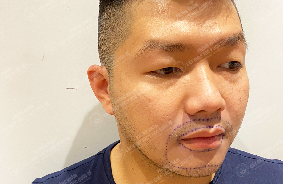 Nguyễn Bá Sơn - Cấy râu 2