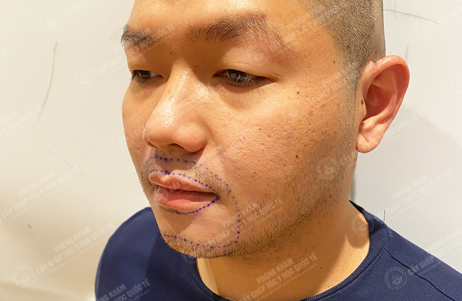 Nguyễn Bá Sơn - Cấy râu 3