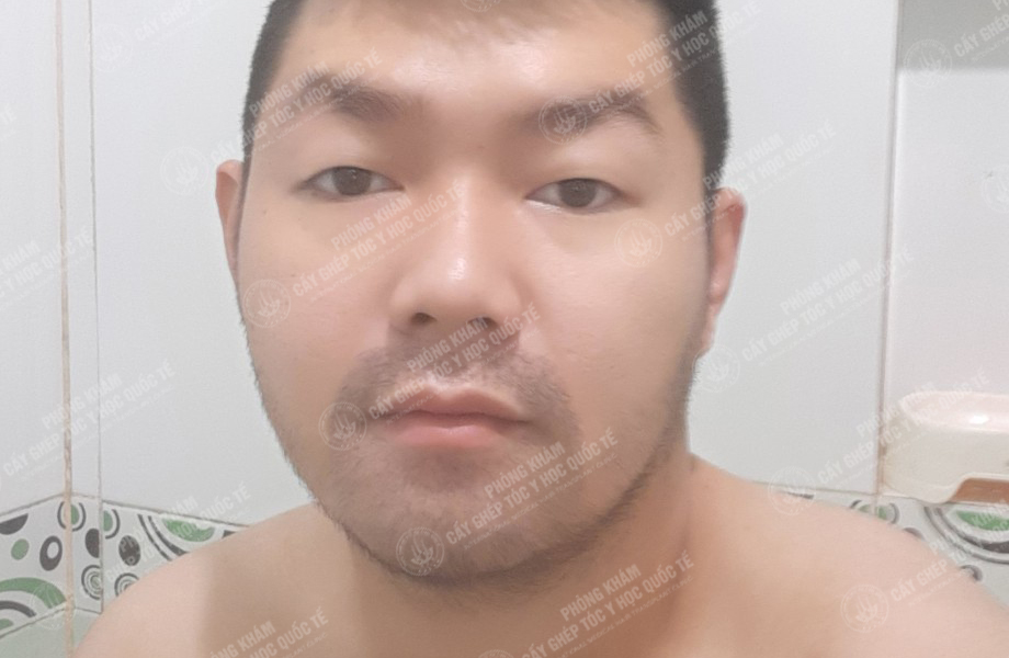 Nguyễn Bá Sơn - Cấy râu 4