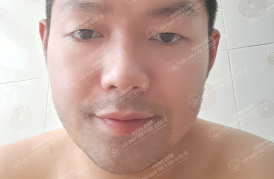 Nguyễn Bá Sơn - Cấy râu 5