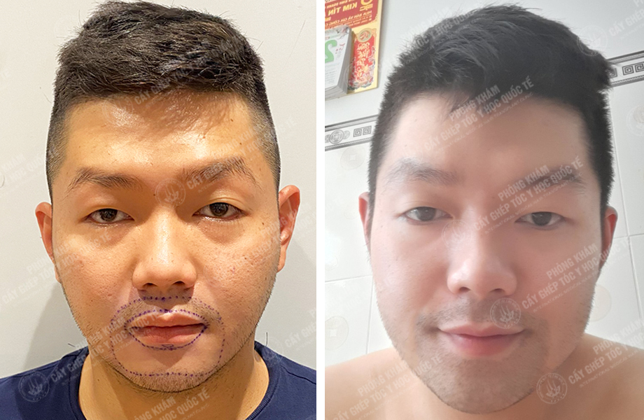  Nguyễn Bá Sơn - Cấy râu 1