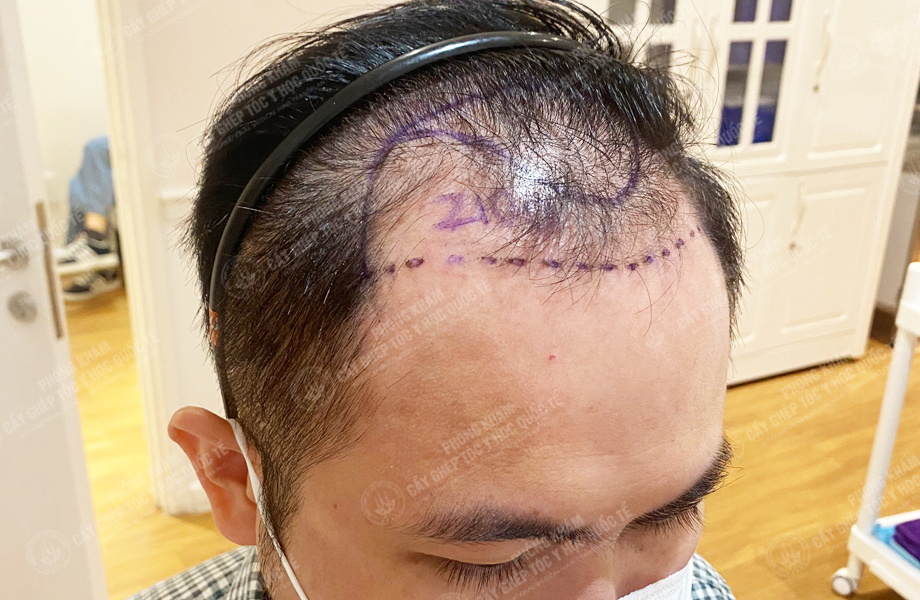 Bùi Văn Lanh - Cấy tóc đường chữ M 2