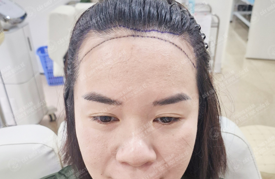 Đỗ Thị Hạnh - Cấy tóc đường chữ M 2