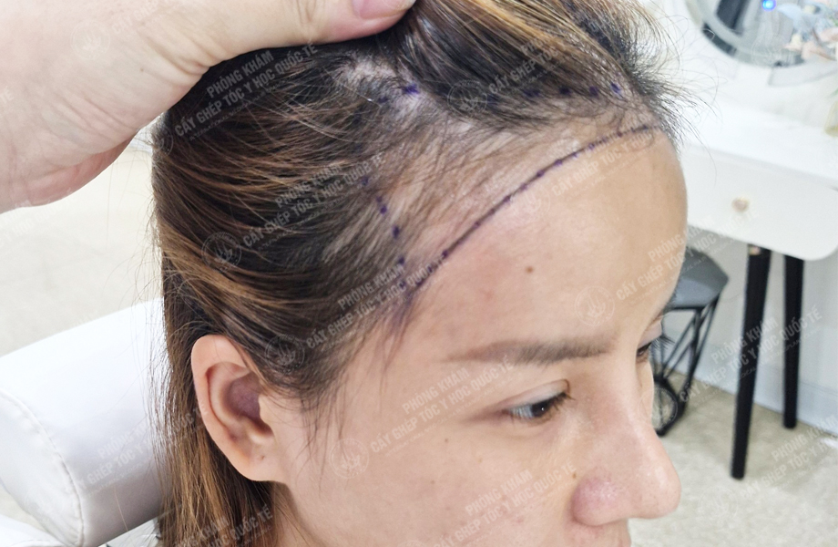 Ngô Thị Hồng - Cấy tóc đường chữ M 2